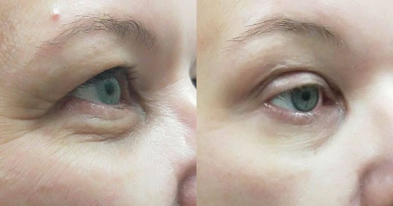 LIDS BY DESIGN: Get Instant Eyelid Lift Without Surgery by Britain