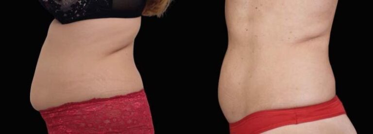 emsculpt before and after